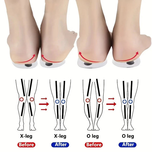 1Pair Orthopedic Insoles for Feet O/X Leg Type Valgus Correction Men